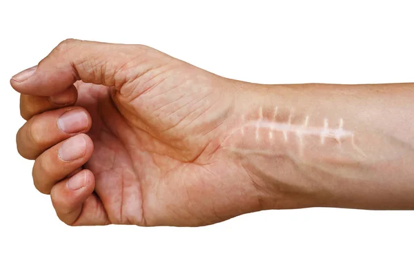 Scar with stitches on the wrist after surgery. Fracture of the bones of the hands in fist isolated on white background — Stock Photo, Image
