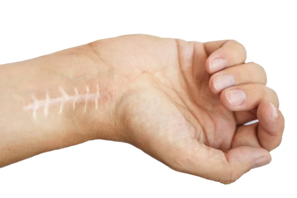Scar with stitches on the wrist after surgery. Fracture of the bones of the hands in fist isolated on white background — Stock Photo, Image