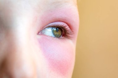 bir arı sokması sonra çocuğun gözlerinin altında büyük kırmızı çürük