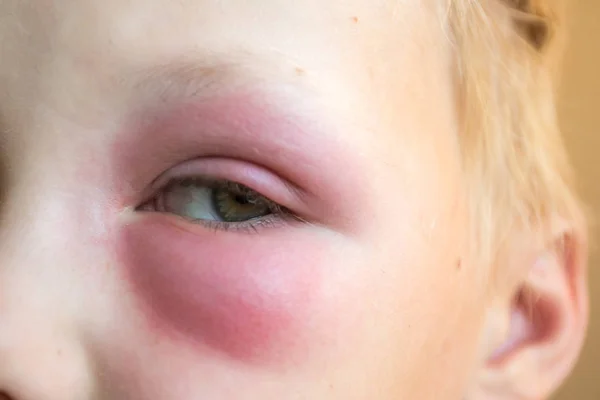 Grande hematoma vermelho sob os olhos do menino, depois de uma picada de abelha — Fotografia de Stock