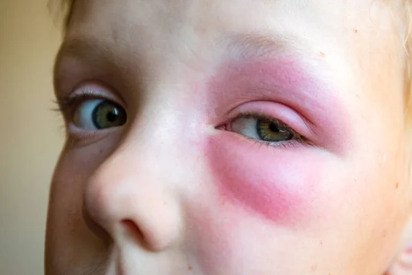 Grande hematoma vermelho sob os olhos do menino, depois de uma picada de abelha — Fotografia de Stock