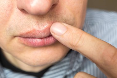 Üst dudağında kırmızı iltihap ve herpes zoster virüsü.