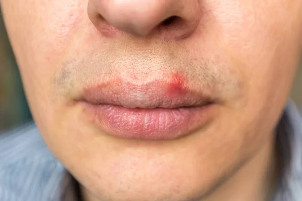 Red inflammation and herpes zoster virus on upper male lip — Stock Photo, Image