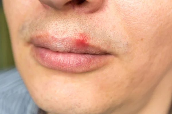 Inflamação vermelha e vírus herpes zoster no lábio superior masculino — Fotografia de Stock