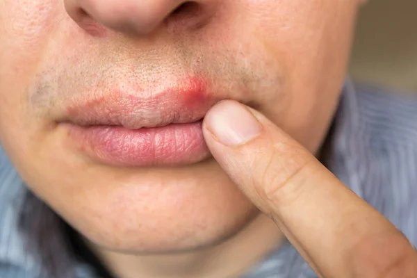 Inflamação vermelha e vírus herpes zoster no lábio superior masculino — Fotografia de Stock