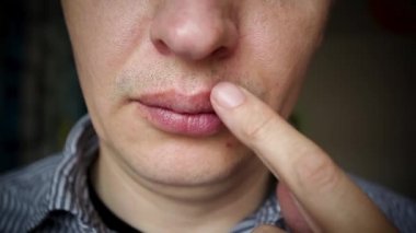 Adam merhem ile kayganlaştırıyor kırmızı iltihap ve üst dudağında uçuk zoster virüsü.