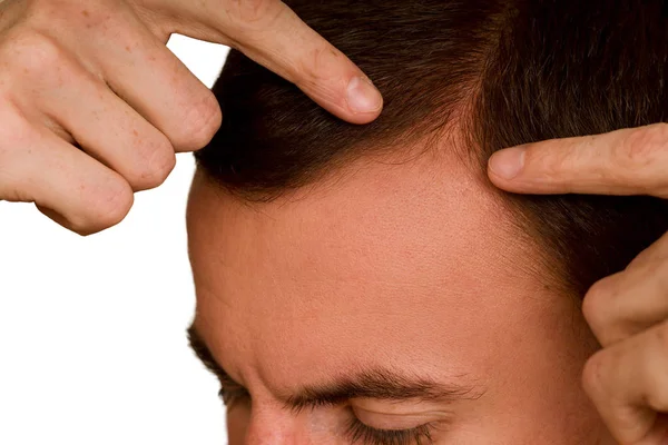 The guy spreads the hair on his head with his hands. Problem of hair loss in men.