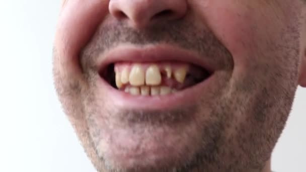 Uomo Apre Bocca Indica Con Dito Suoi Denti Rotti Male — Video Stock