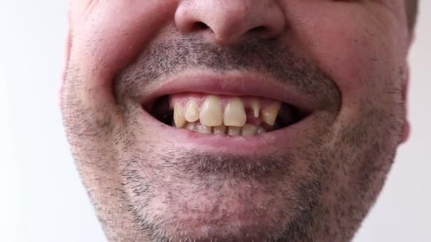 Мужчина Открывает Рот Показывает Пальцем Сломанные Зубы Крупным Планом Белом — стоковое видео