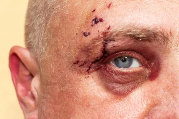 Manligt öga med ett stort lila blåmärke. Bitande hund på ansiktet. Ögonskada. Stora blåmärken på det manliga ögat. Behandling av skador. Boxer Eye. — Stockfoto