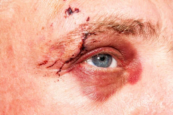 Mannelijk oog met een grote paarse kneuzing. Bijt hond op gezicht. Oogletsel. Grote blauwe plekken op het mannelijke oog. Behandeling van verwondingen. Boxer Eye. — Stockfoto