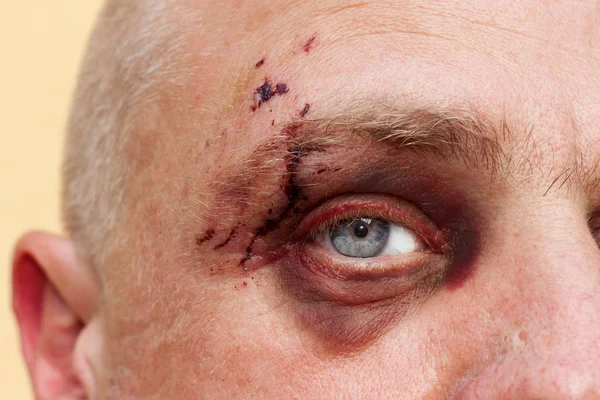 Male eye with a large purple bruise. Biting dog on face. Eye injury. Large bruising on the male eye. Treatment of injuries. Boxer eye.