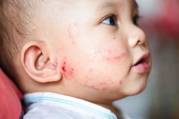 rash baby allergy on face / disease baby girl face dry skin itching and lesion caused from allergy in newborn baby asia