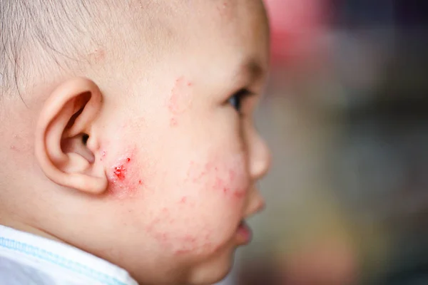 Сыпь Детская Аллергия Лицо Болезнь Детское Лицо Ребенка Сухой Зуд — стоковое фото