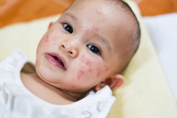 Rash alergi bayi di wajah — Stok Foto