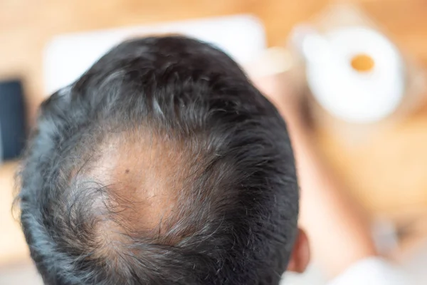 Foco Homem Cabeça Tem Problema Perda Cabelo — Fotografia de Stock