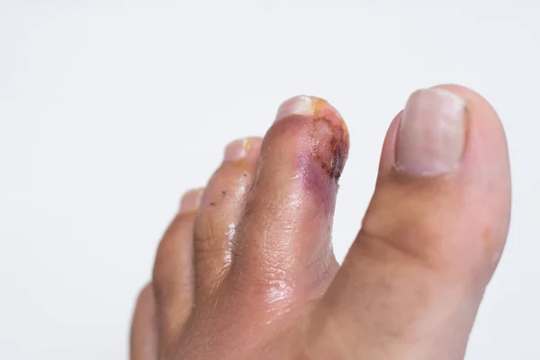 Dedo en la pierna. Dedo purulento. Herida de cerca. herida purulenta —  Fotos de Stock