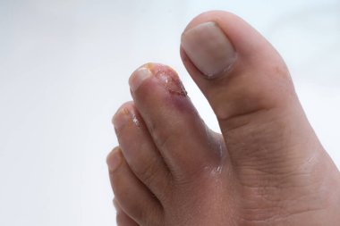 Parmak bacak. Pürülan bacak yarası. Egzama. Dermatit. Sedef.