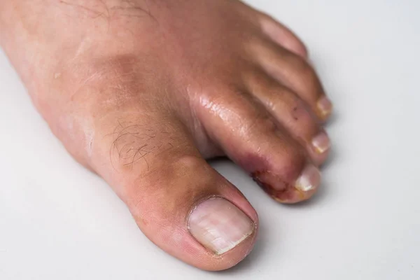 Dedo en la pierna. Herida purulenta en la pierna. Eccema. Dermatitis. Psoriasis . —  Fotos de Stock