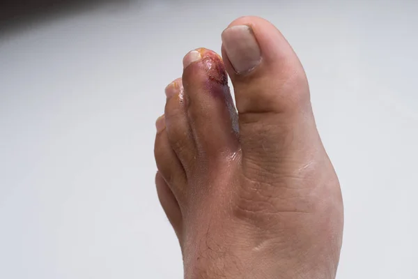 Dedo en la pierna. Herida purulenta en la pierna. Eccema. Dermatitis. Psoriasis . —  Fotos de Stock