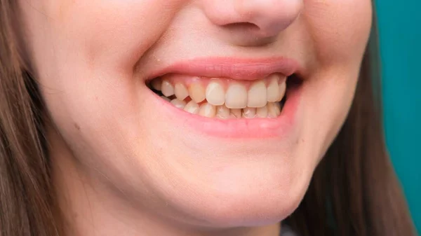 Female Yellow teeth, fluorosis. Smokers problem teeth caused by fluoride, smoking, or coffee. Brown tooth enamel due to illness and medicine. Natural photo. — Stock Photo, Image