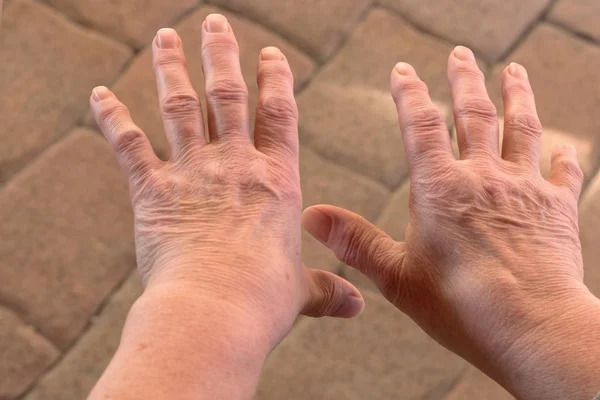 Bunlar parmak ağrısı olan yaşlı bir kadının elleri.