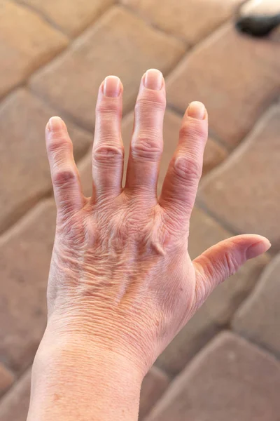 These are hands of a old woman with finger pain