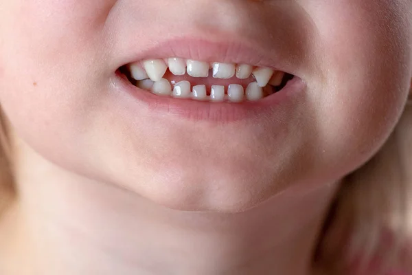 Primo piano di un bambino sdentato sorridente, dente da latte — Foto Stock