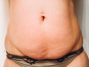 Hamilelik sonrası vücut. sarkık göbeği. cesarean bölüm