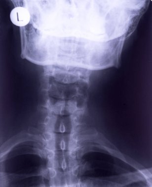 X-ray of neck, frontal projection. Cervical sprain rectification of lumbar lordosis clipart