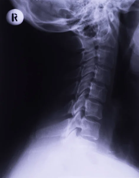 Röntgenbild Des Halses Seitliche Projektion Korrektur Der Lendenwirbelsäulenverstauchung — Stockfoto