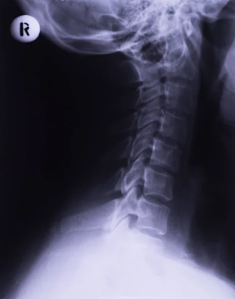 X-ray of neck, lateral projection. Cervical sprain rectification of lumbar lordosis — Stock Image Ray Neck Lateral Projection Cervical Sprain Rectification Lumbar Lordosis Stock Picture