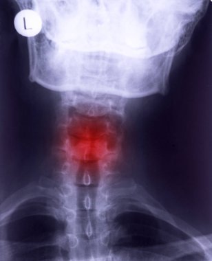 X-ray of neck, frontal projection. Cervical sprain rectification of lumbar lordosis clipart