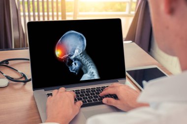 Doktor başının önünde ağrı olan kafatasının röntgenini izliyor. Migren baş ağrısı veya travma kavramı. Radyoloji kavramı