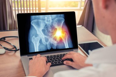 Doktor sağ tarafta ağrı olan kalçaların röntgenini izliyor. Radyoloji kavramı