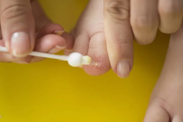 Takin Care Ingrowing Baby Nails Pedicure — Stock Photo, Image