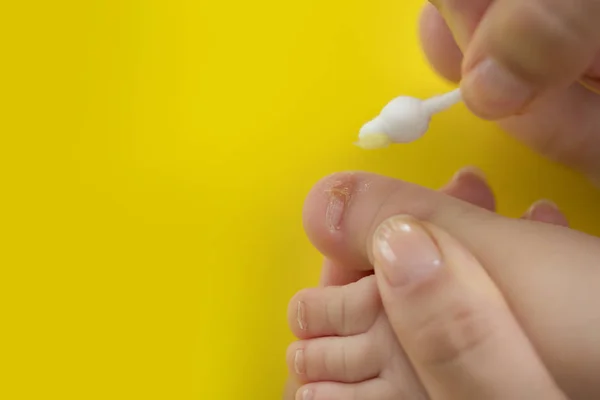 Takin Care Ingrowing Baby Nails Pedicure — Stock Photo, Image