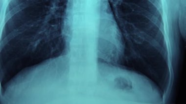 Vücut Xray monitör MRI tarama kırık köprücük kemiğini (köprücük kemiği kırık), insan