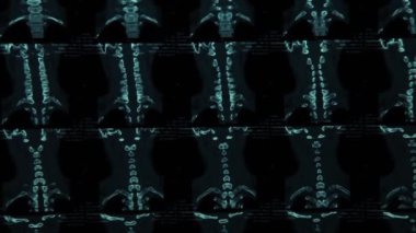 Vertebral sütunun, omurga, MRI tarama, insan vücut Xray monitör