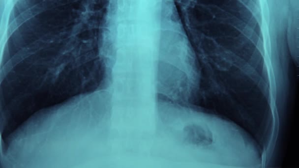 Resonancia Magnética Hueso Roto Del Cuello Clavícula Rota Monitor Rayos — Vídeo de stock