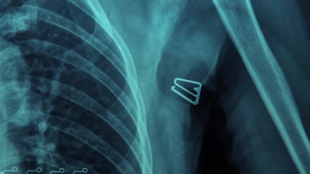 Resonancia Magnética Hueso Roto Del Cuello Clavícula Rota Monitor Rayos — Vídeo de stock