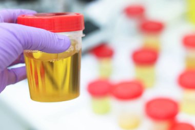 Klinik tıp laboratuvarında idrar muayenesi