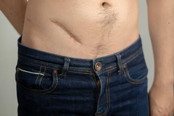 Man toont de maag met een litteken van appendicitis chirurgie. Hge — Stockfoto