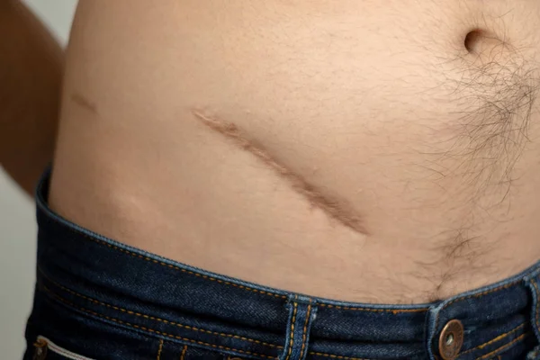 Homem mostrando o estômago com uma cicatriz de cirurgia de apendicite. — Fotografia de Stock