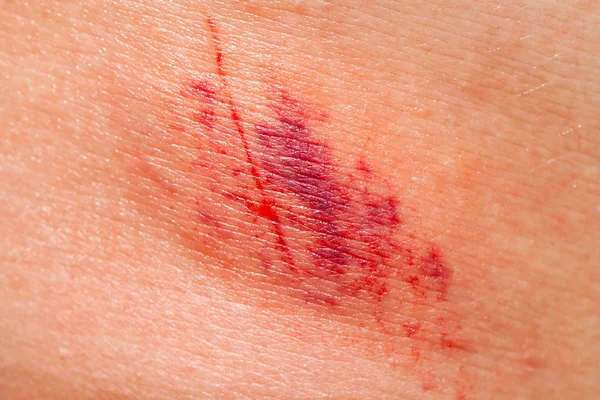 Nahaufnahme Einer Schmerzhaften Subkutanen Verletzung Der Menschlichen Haut — Stockfoto