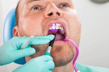 Diş tedavisi ağız boşluğu polimerizasyon lambalı. Erkek hasta yakından