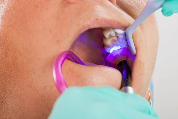 Tratamento Dentário Com Lâmpada Polimerização Cavidade Oral Paciente Masculino Perto — Fotografia de Stock