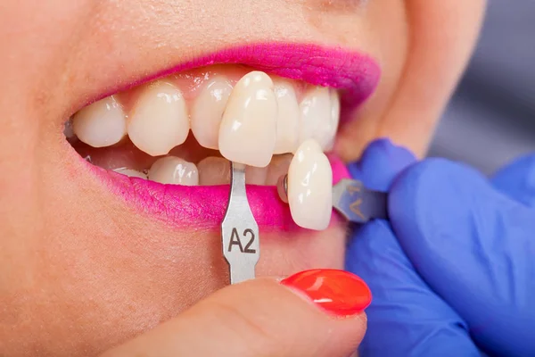 Determinazione Dell Ombra Dentale Con Guida All Ombra Paziente Donna — Foto Stock