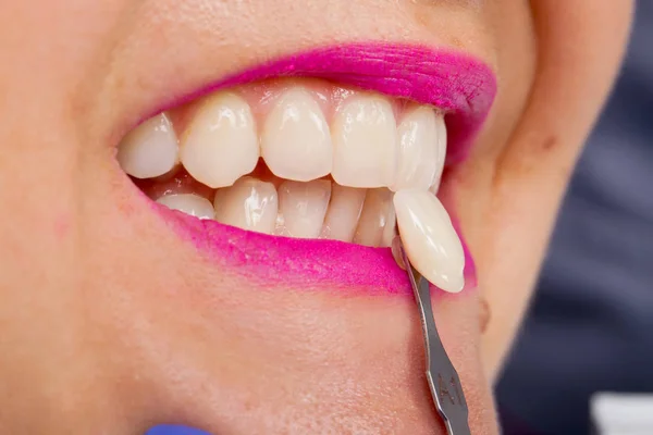 Dental Shade Determination Shade Guide Female Patient Wearing Pink Lipstick — Stock Photo, Image