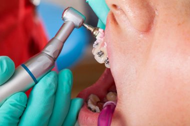 Genç kadının ağzına resmi oluşturan kapatın. Diş diş teli - tedavi